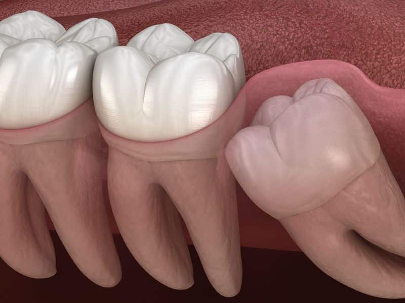 bölcsességfog eltávolítás műtéttel