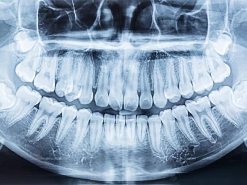 fogaszáti panoráma röntgen