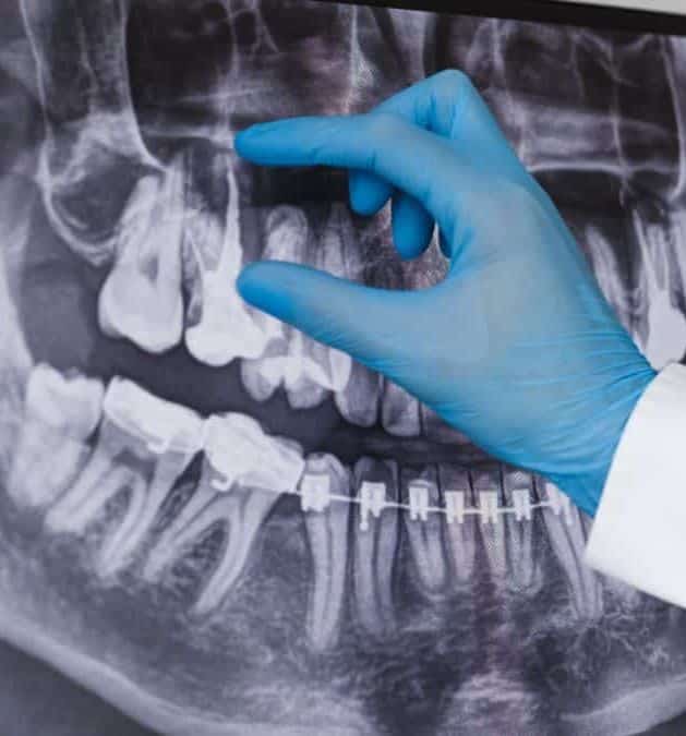 foggyökér röntgen