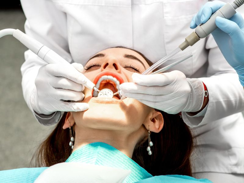 ultrahangos fogkő eltávolítás