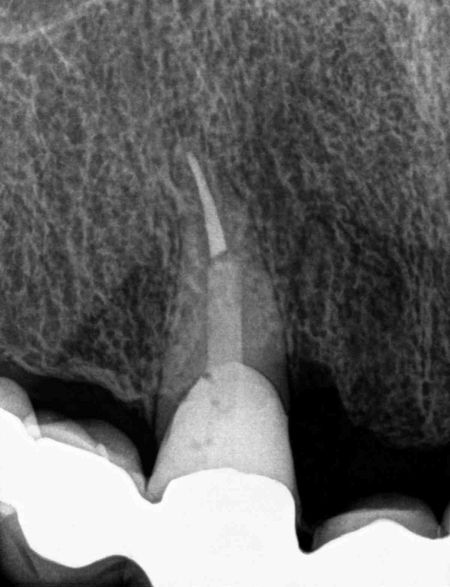 gyökércsúcs rezekció röntgen felvétel