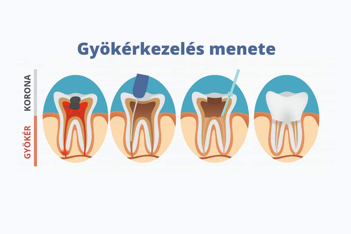 gyokerkezeles-menete-infog.jpg