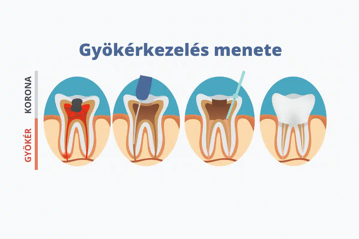 gyokerkezeles-menete-infog.jpg