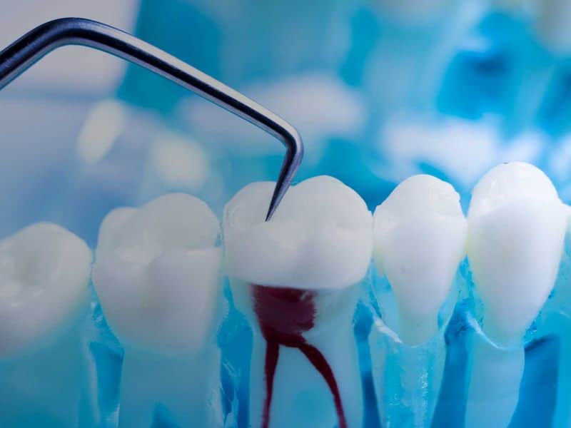 Gyökérkezelés illusztráció